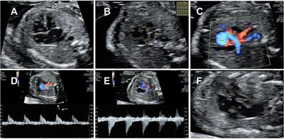 Prenatal echocardiographic diagnosis of a discontinuous left pulmonary artery with Taussig–Bing syndrome: a case report and literature review